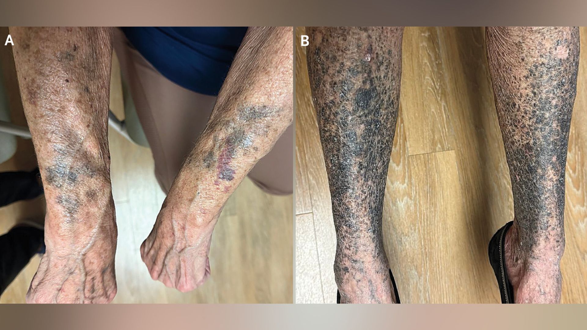 Dilema Diagnóstico: Uma Mulher Torna-se Negra e Azul Semanas Após Iniciar um Novo Medicamento