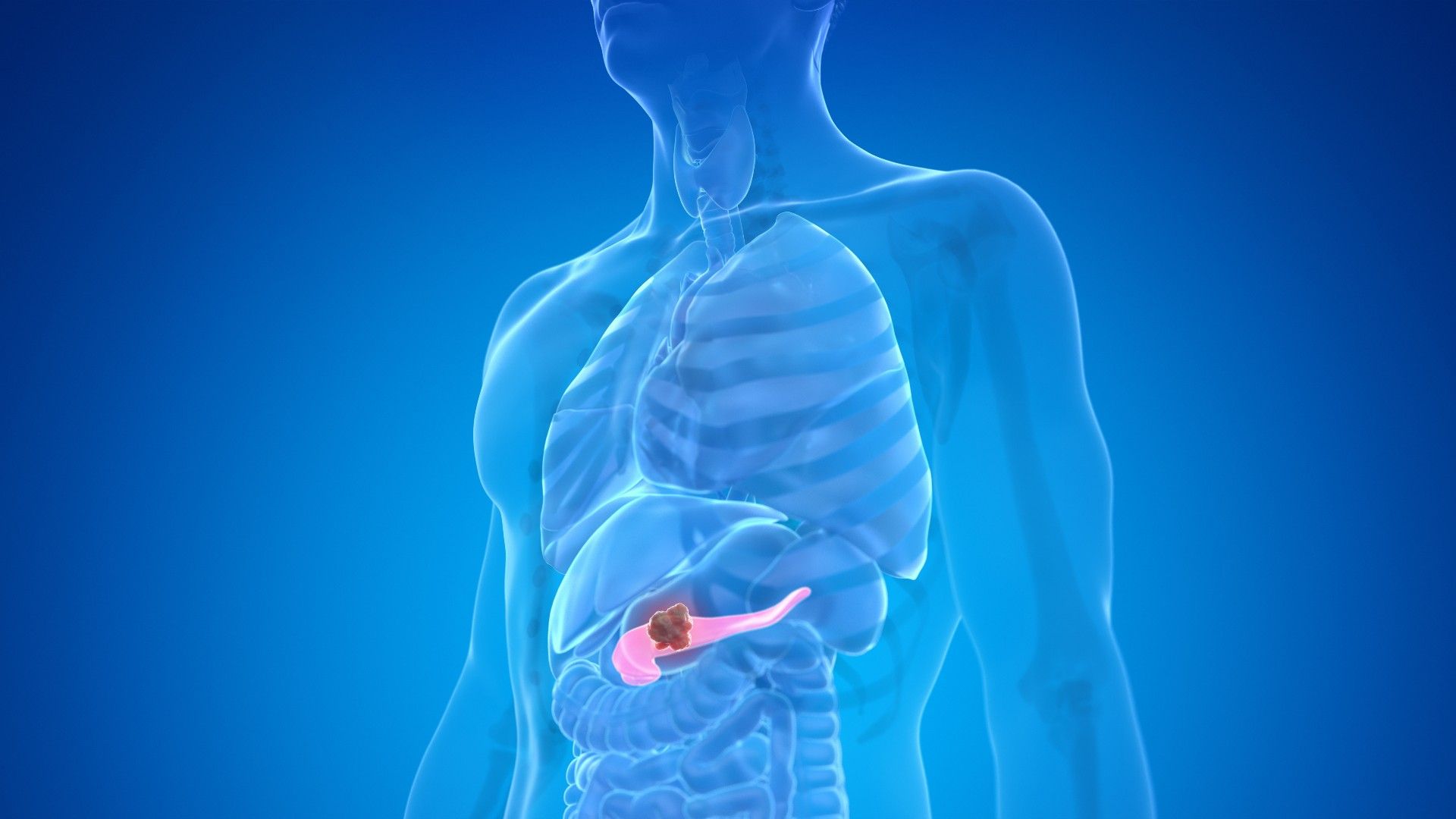 Revolução na Detecção do Câncer Pancreático: Novo Modelo de IA Identifica Doença Até 3 Anos Antes