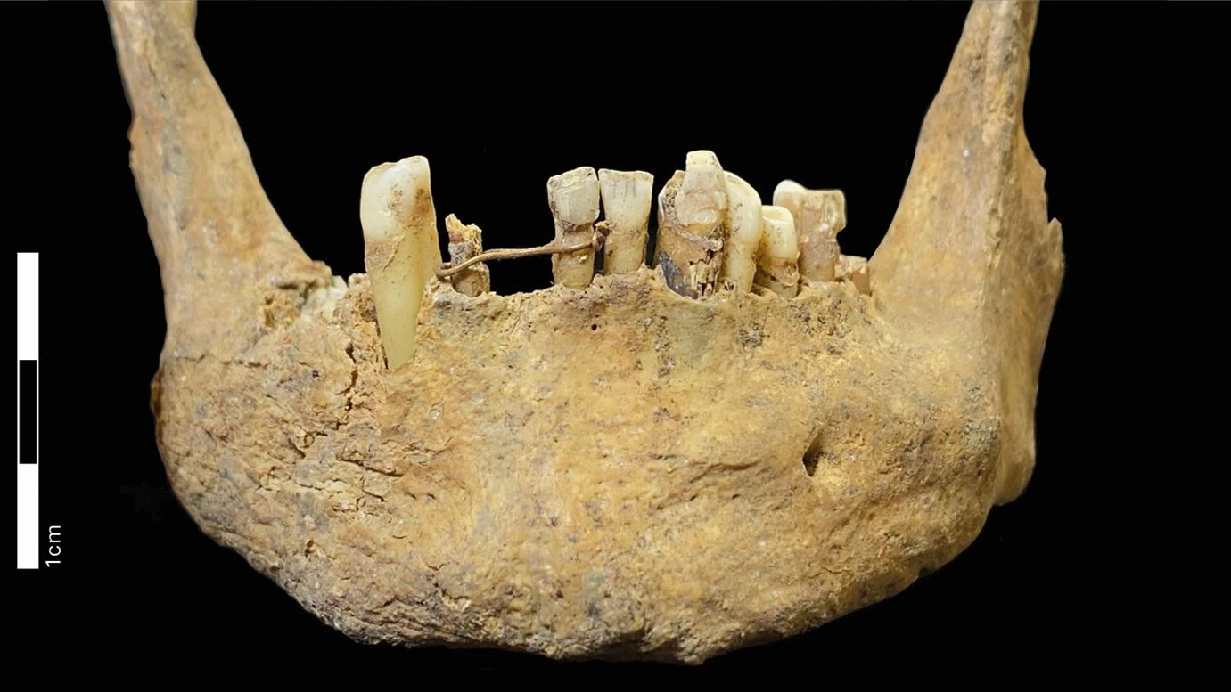 Descoberta revela ponte dental de ouro de 500 anos na Escócia como um marco em cuidados orais