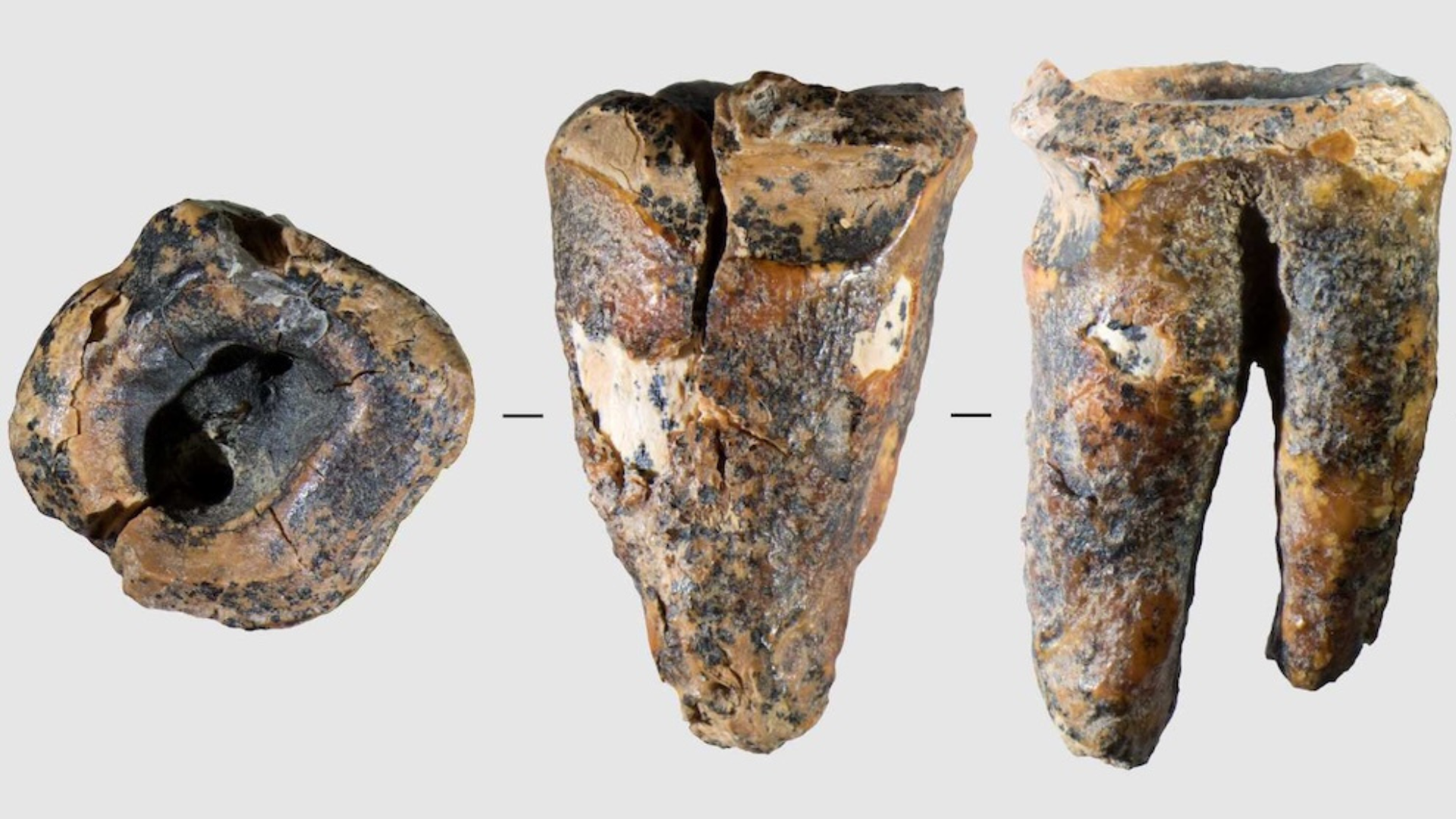 Neanderthais e a Prática de Odontologia: A Descoberta do Dente Drilhado de 60.000 Anos em Sibéria