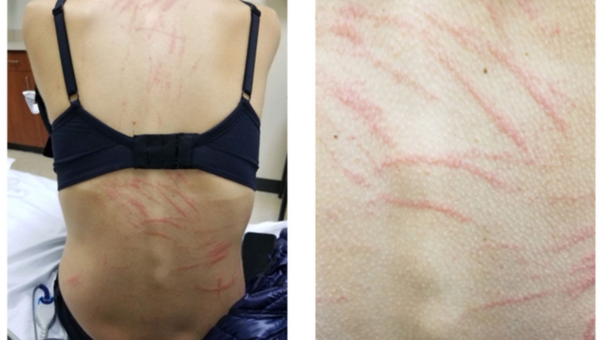 O Enigma Dermatológico: O Caso das Marcas de Chicote após o Consumo de Shiitake